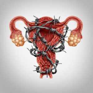 Endometriosis